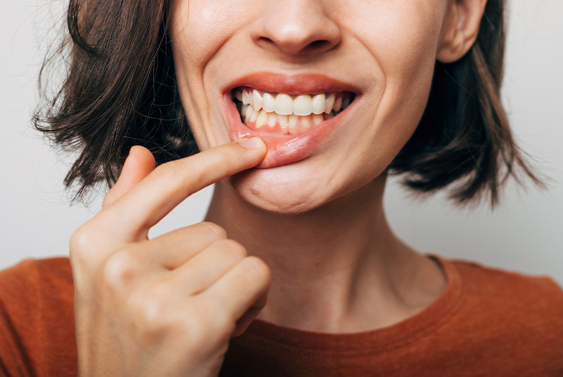 patient with gum disease showing her teeth