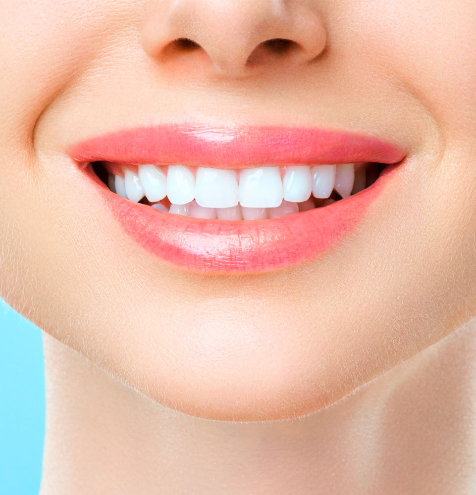 Professional teeth whitening at Ancira Family Dental